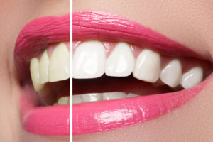 the risks of teeth whitening