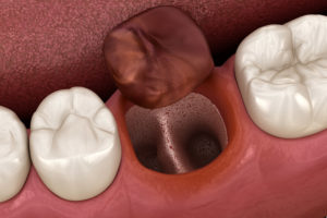 Dry Socket After A Tooth Extraction