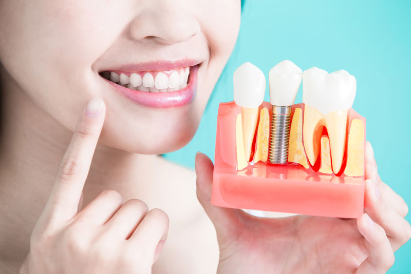 Dental Patient Holding Her Dental Implant Model