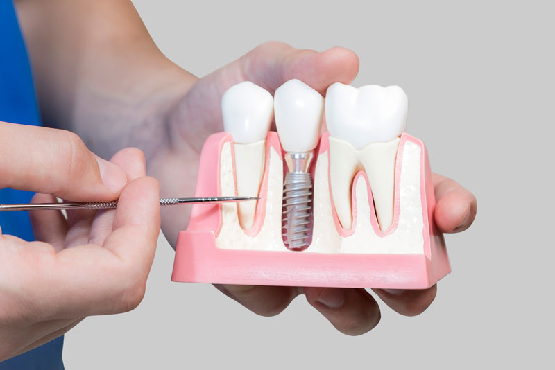 Bone Cutaway Showing A Dental Implant Screw Model