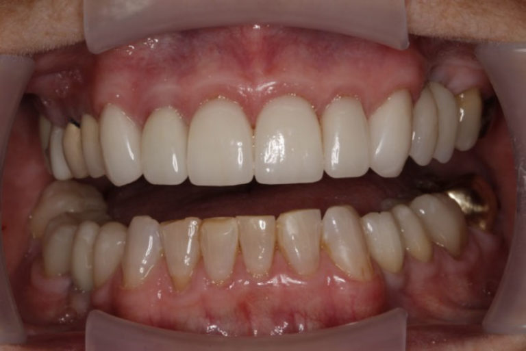 Dental Implant Patient 01 - Before