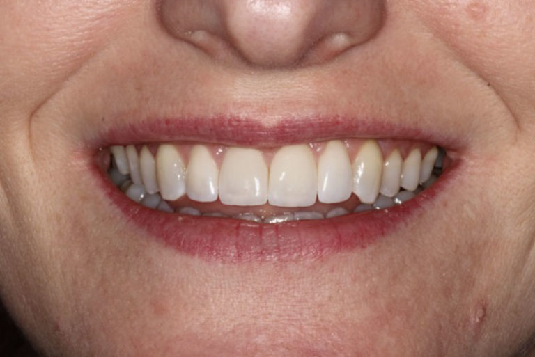 Dental Implant Patient 02 - After