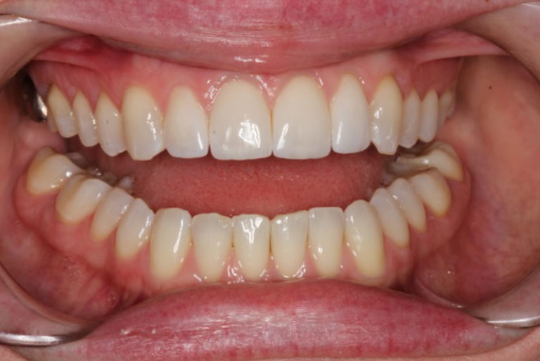 Dental Implant Patient 02 - Before