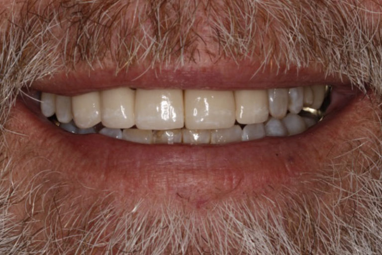 Dental Implant Patient 03 - After