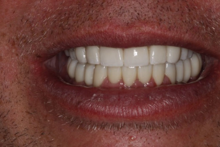 Dental Implant Patient 04 - After