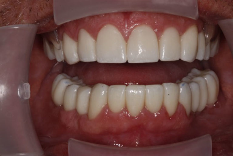 Dental Implant Patient 04 - Before