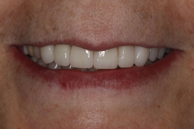 Extractions, Bone Grafts, Dental Implants, Crowns, Whitening. Post Procedure Smile.