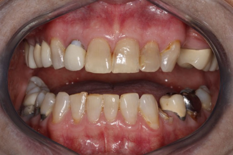 Extractions, Bone Grafts, Dental Implants, Crowns, Whitening. Before Procedure.