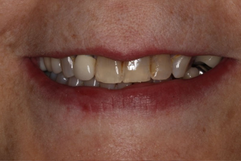 Extractions, Bone Grafts, Dental Implants, Crowns, Whitening. Before Procedure Smile.