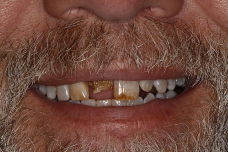 SRP, Extractions, Bone Graft, Fillings, Crowns, Dental Implants. Before Procedure Smile.