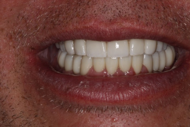 Extractions, Dental Implants, Fillings, and Crowns. Post Procedure Smile.
