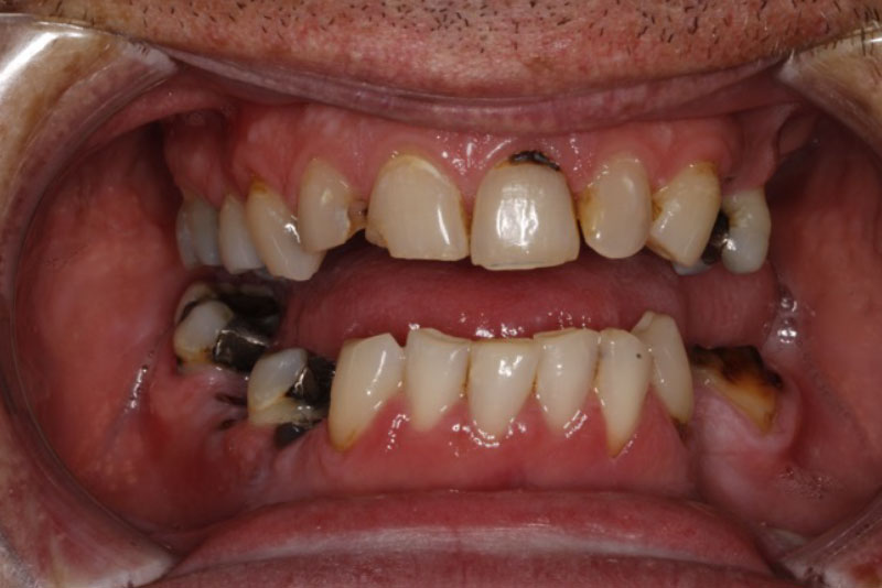 Extractions, Dental Implants, Fillings, and Crowns. Before Procedure.