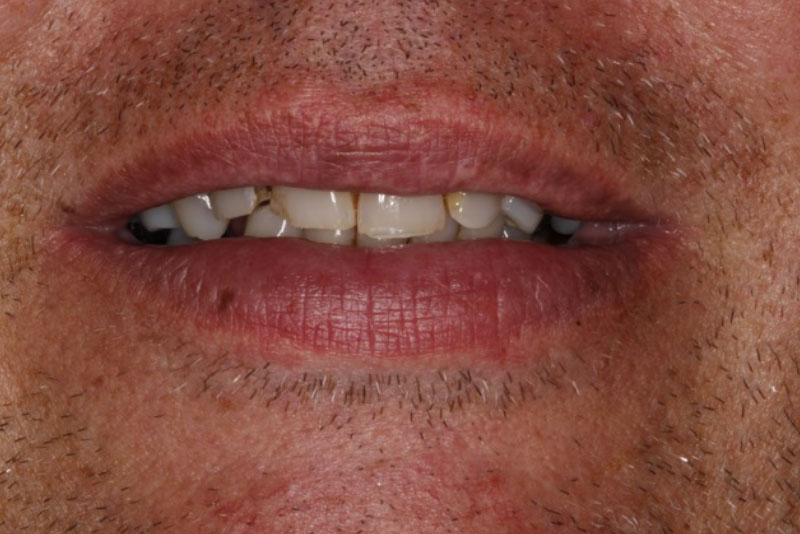 Extractions, Dental Implants, Fillings, and Crowns. Before Procedure Smile.